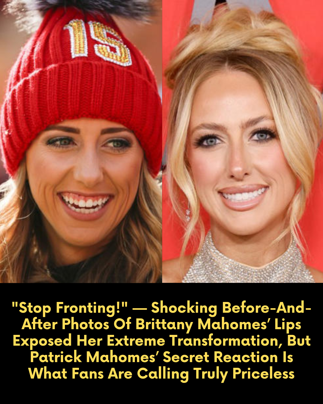 “Stop Fronting!” — Shocking Before-And-After Photos Of Brittany Mahomes’ Lips Exposed Her Extreme Transformation, But Patrick Mahomes’ Secret Reaction Is What Fans Are Calling Truly Priceless.